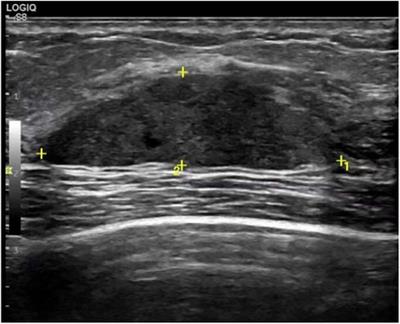 Chylous fistula after right breast fibroadenoma resection: a case report